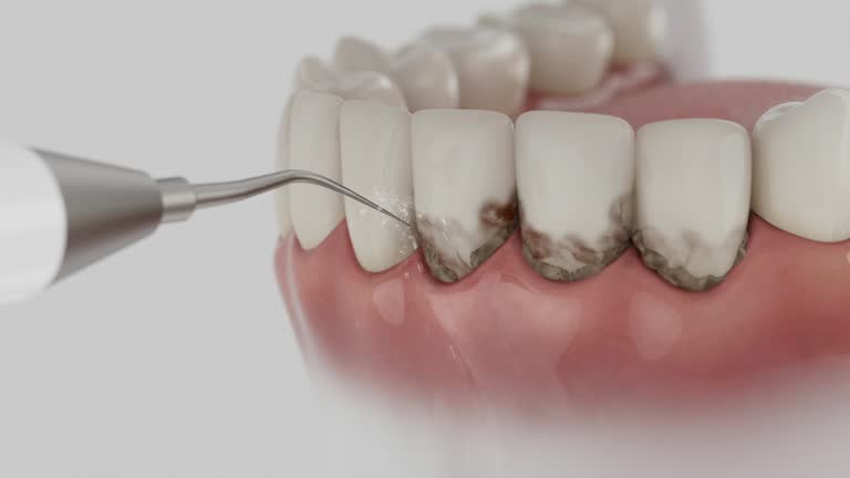 Trusted Wisdom Tooth Removal service in Florence, MS - Dentist Open Now